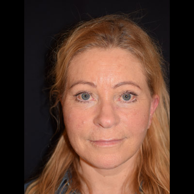 Efter ansiktslyft