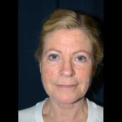 Före ansiktslyft