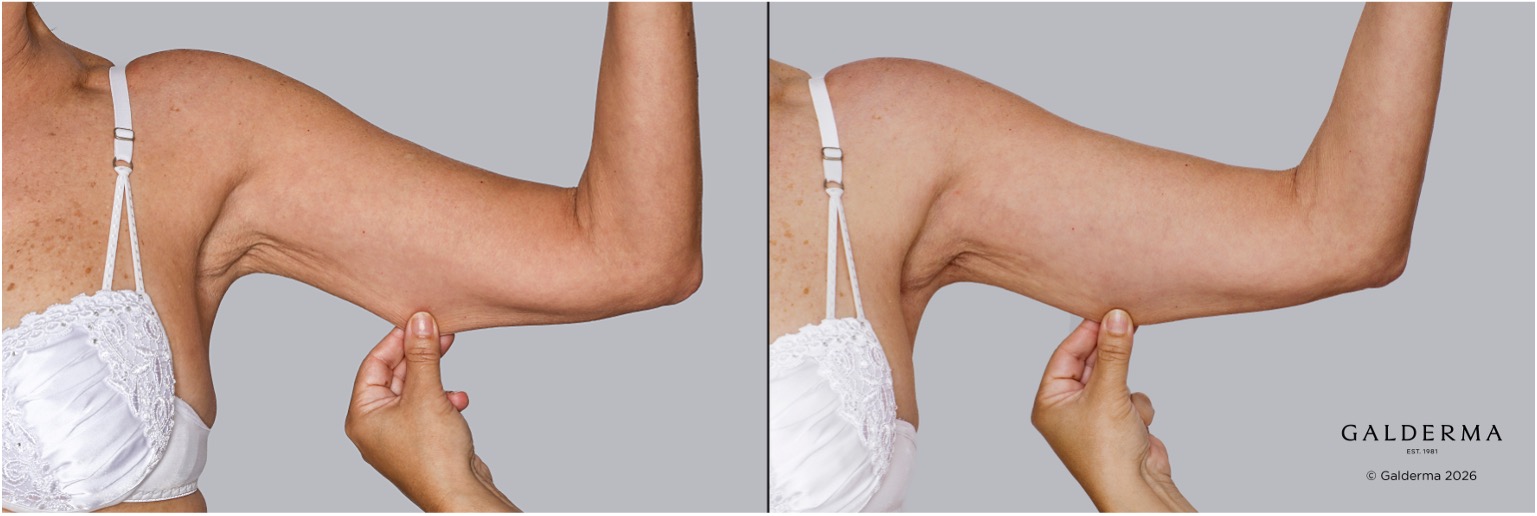 Före- och efterbilder på patient harPatient före och en tid efter Sculptra injektionsbehandling.