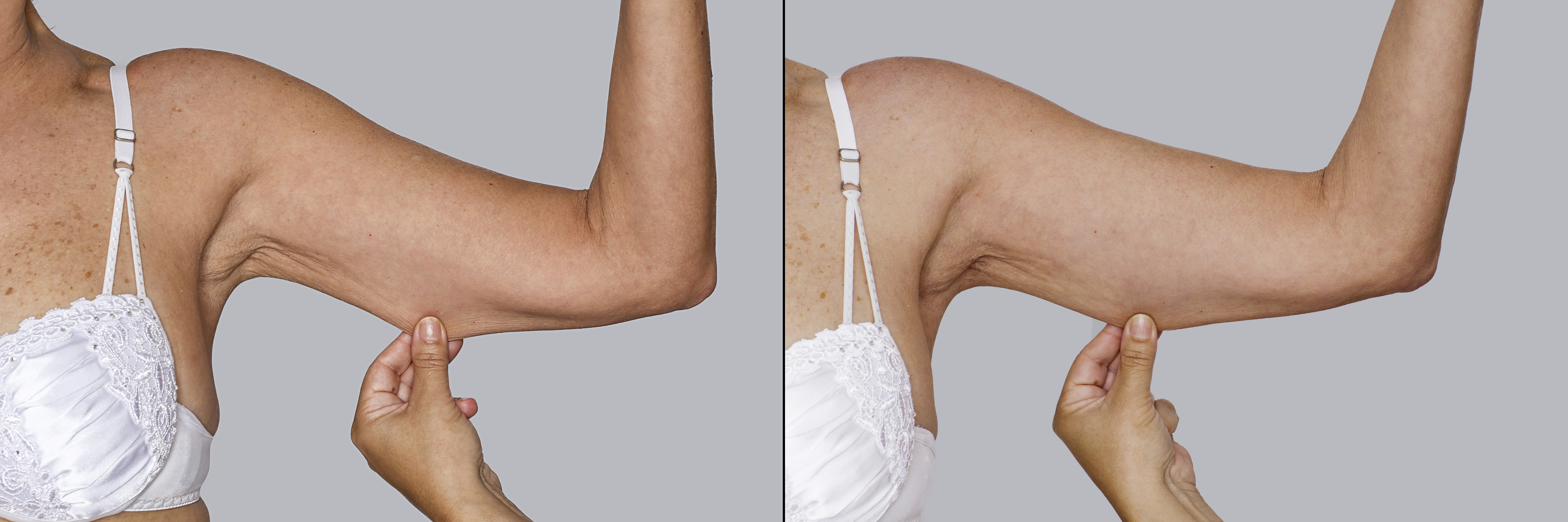 Före- och efterbilder på patient harPatient före och en tid efter Sculptra injektionsbehandling.